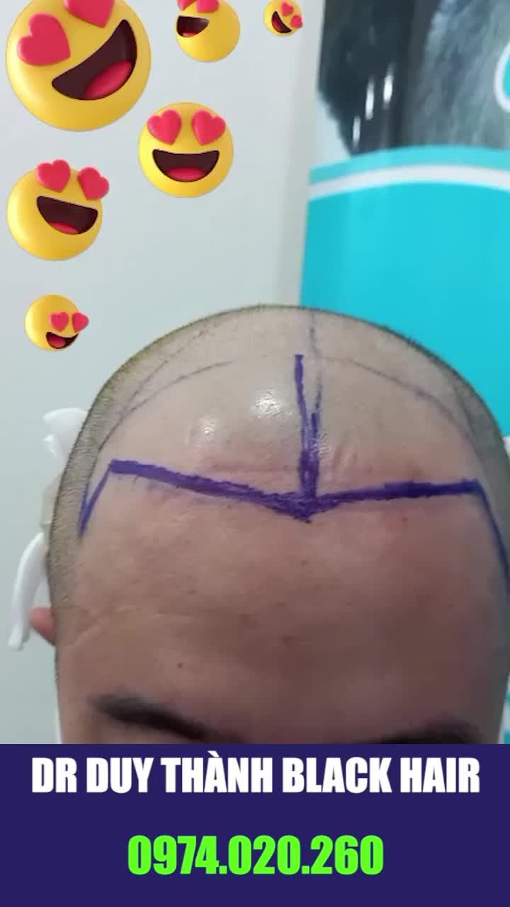 Đẳng cấp cấy tóc là đây