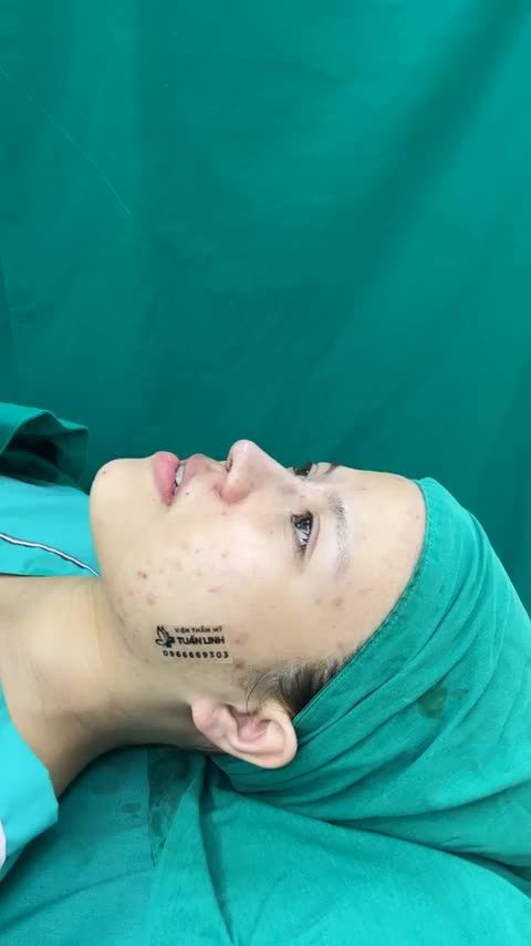 Case mũi Siêu cấu trúc sụn surgiform vừa hoàn thành!!!