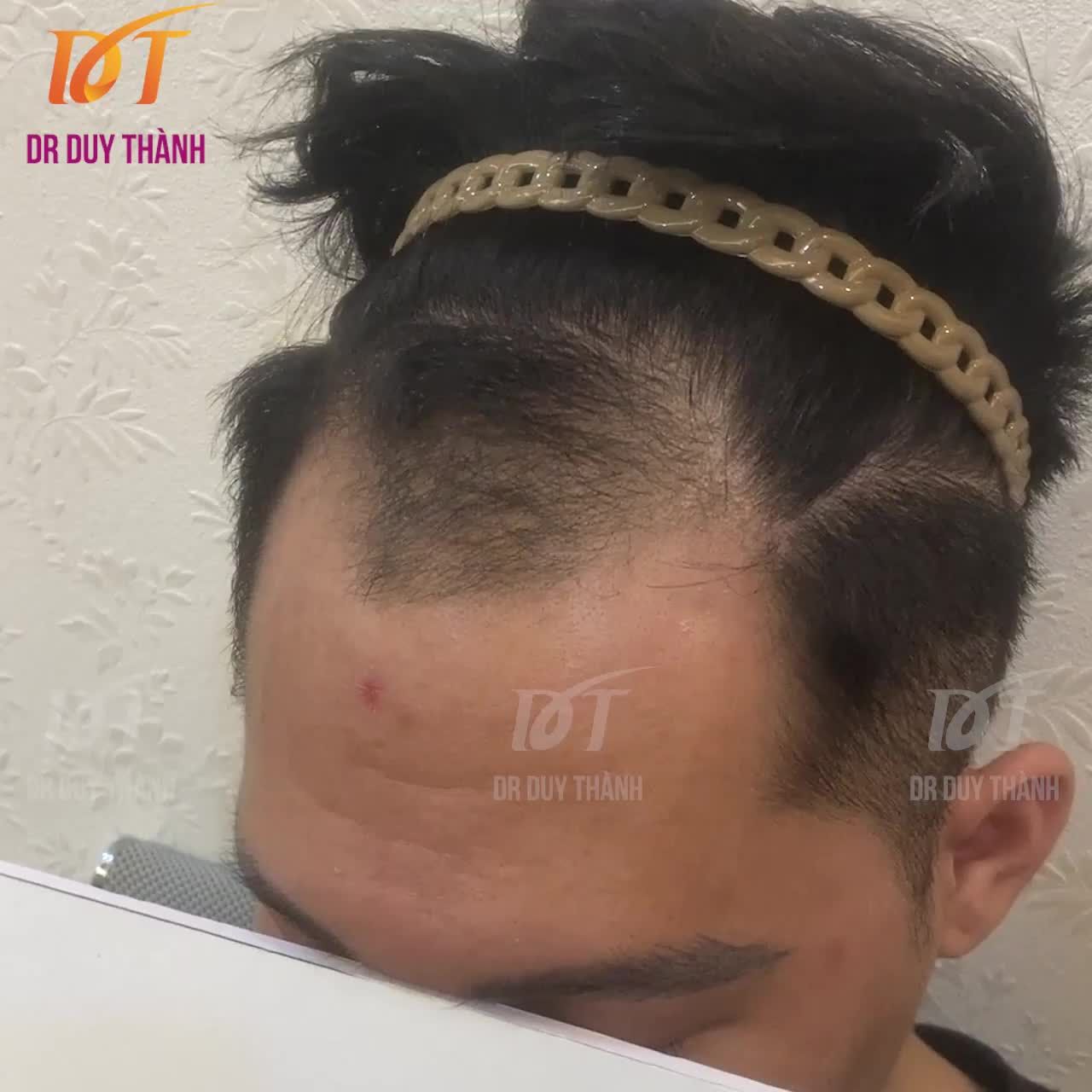 CẤY 1500 NANG TÓC KHẮC PHỤC HÓI CHỮ M VÀ TÓC THƯA VÙNG TRÁN