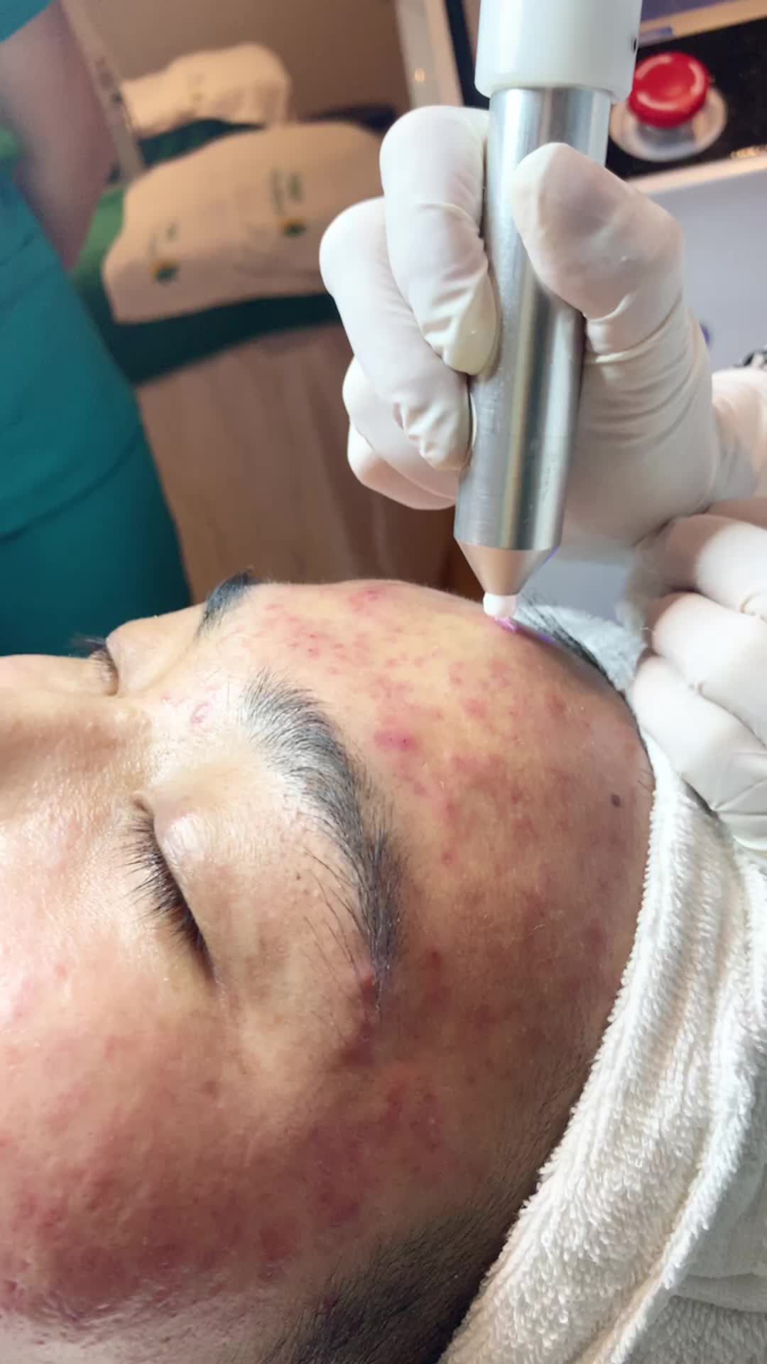 NẶN MỤN XONG THÌ PHẢI SÁT KHUẨN NGAY