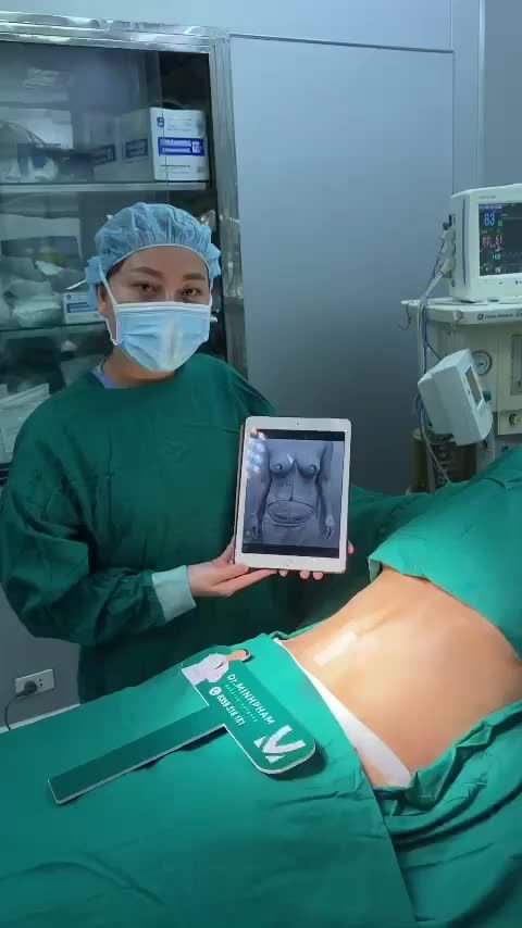 Ca Combo Hút mỡ tạo hình thành bụng + Ngâng ngực vừa được thực hiện bởi ekip Dr. Minh Phạm