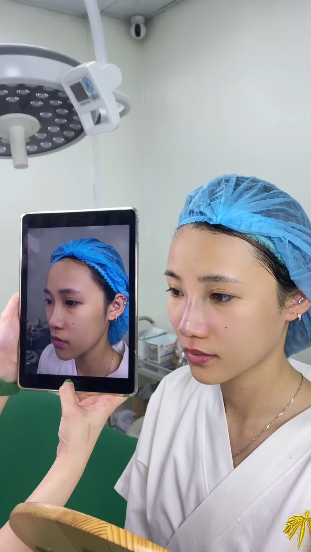 Cận cảnh mũi Surgiform bác sĩ Thẩm mỹ viện Tấm vừa hoàn thiện
