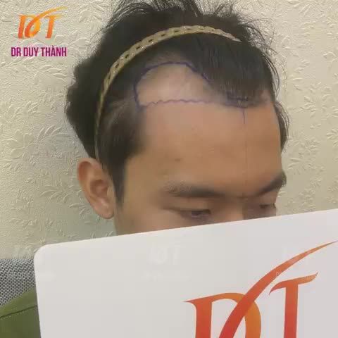 Cấy tóc là một phẫu thuật tinh vi, đòi hỏi kỹ năng tốt, sự tập trung cao độ và sự phối hợp nhịp nhàng của cả một ê-kíp.