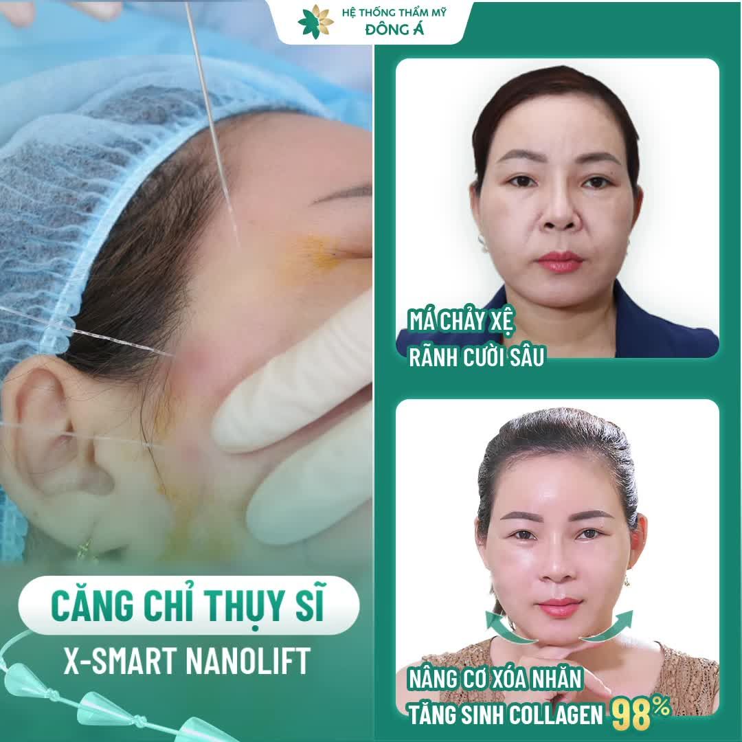 Chị Hoa(45T) Xóa sổ má chảy xệ, rãnh cười sâu