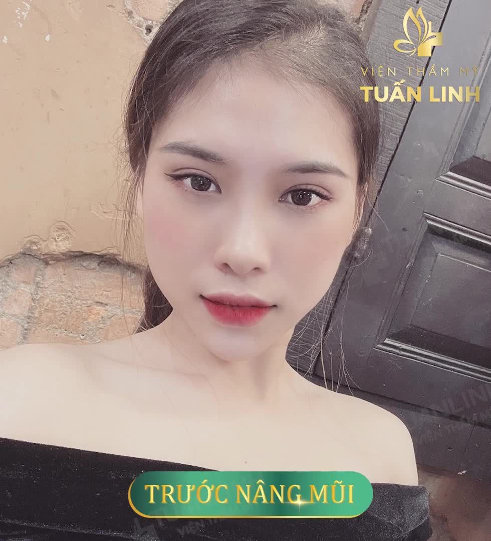 Cô nàng 2K2 không uổng công bay từ HUẾ vào TPHCM để nâng mũi!!!