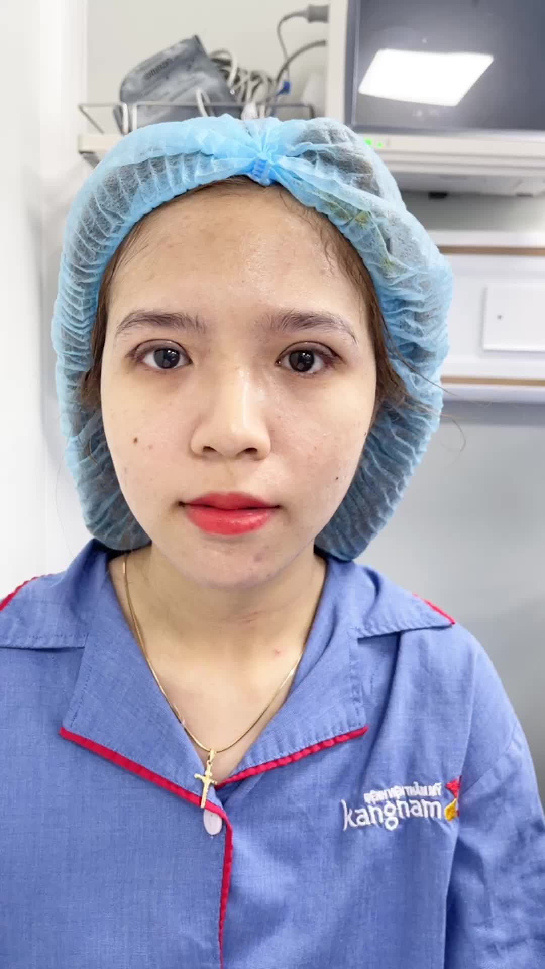 Kết quả Cắt mí 6D sau 30 phút