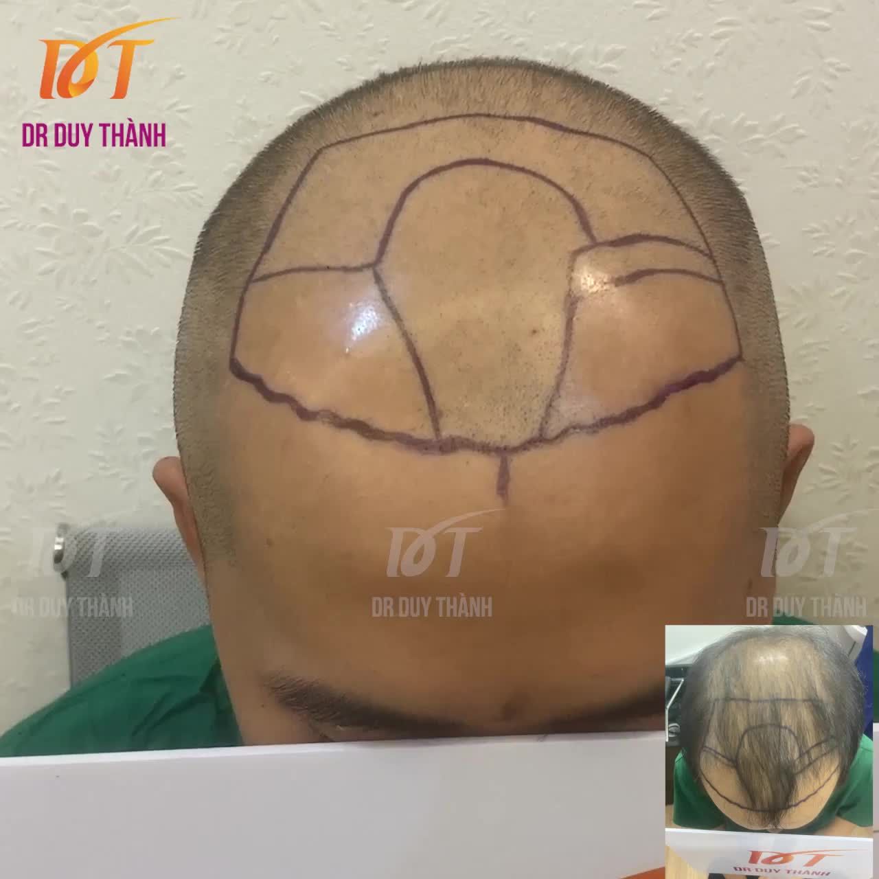 Bạn nam bị hói diện rộng, sợi tóc mảnh, mong muốn cấy trên 3000 nang tóc.