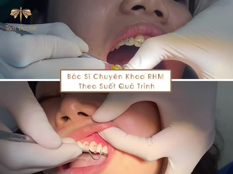 Điều trị dứt điểm Hô - Thưa - Móm - Khấp khểnh với Tấm Dentist