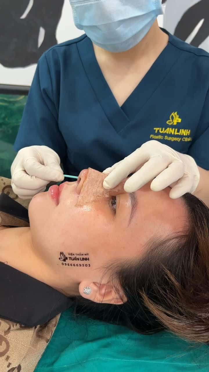 Khách hàng nâng mũi siêu cấu trúc sụn surgiform thay nẹp sau 5 ngày!!!