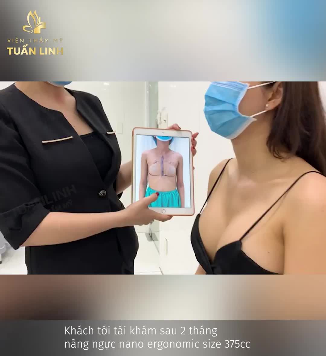 CẬN CẢNH V1 NANO ERGONOMIC SAU 2 THÁNG TÁI KHÁM