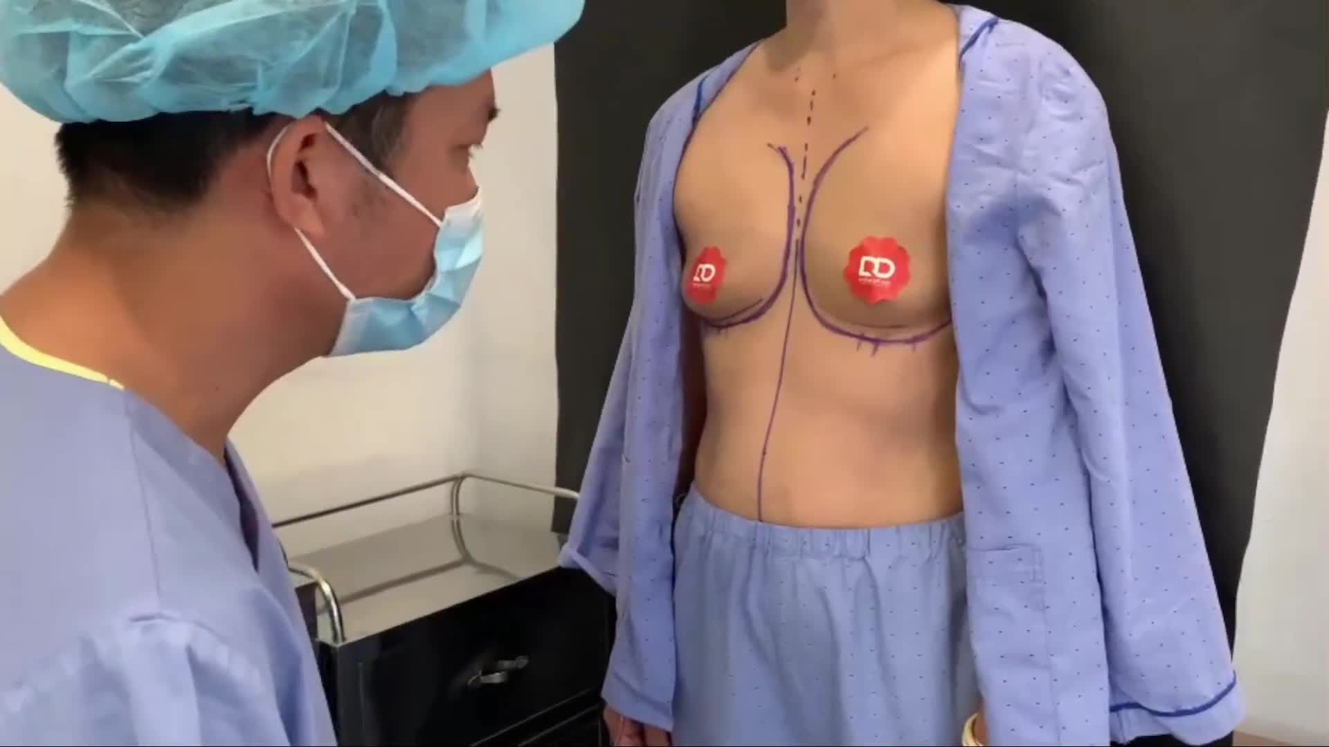 Đặt túi ngực để khắc phục tình trạng tuyến vú teo lép sau sinh