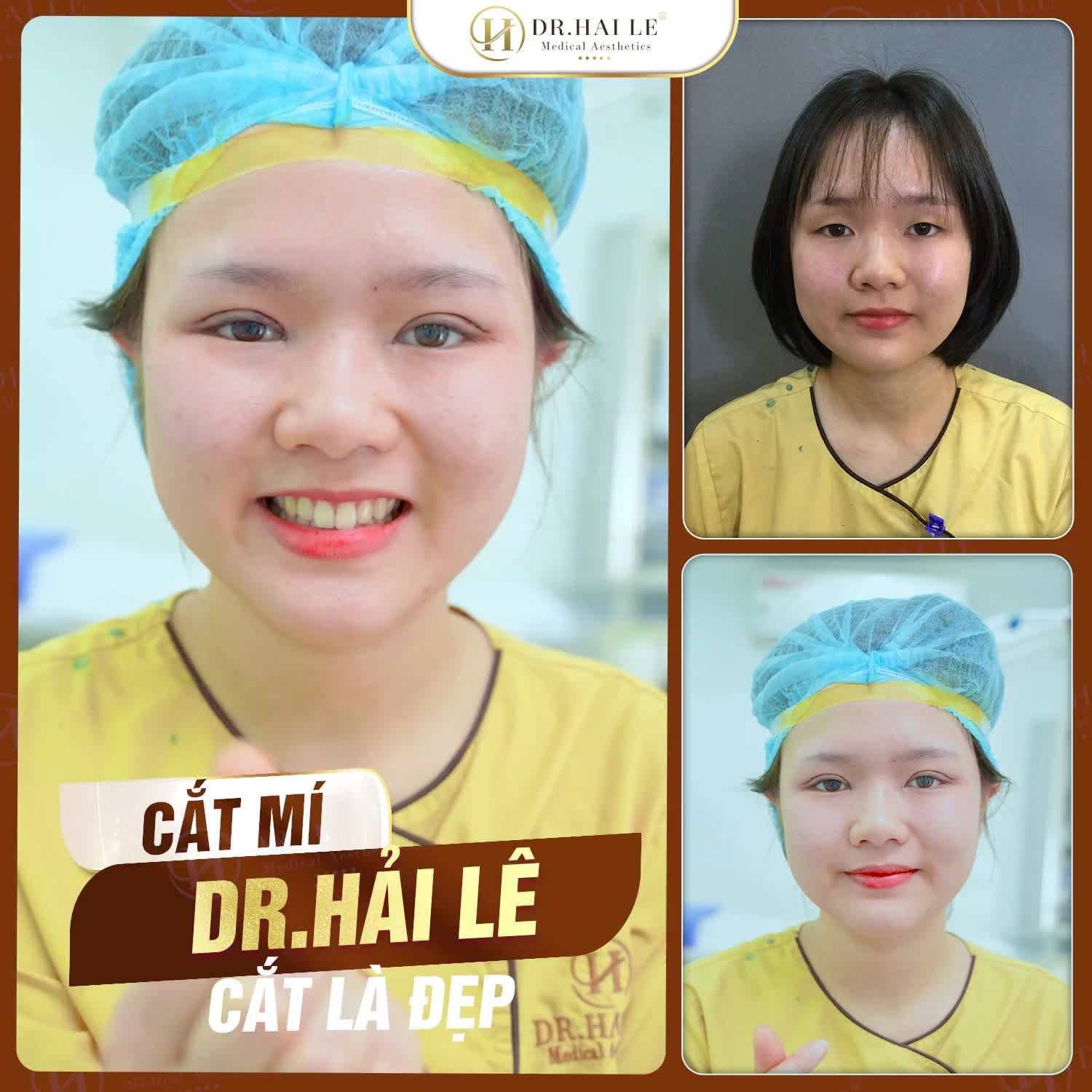 LỜI ĐỒN Cắt mí đau lắm, lại nhìn giả trân, tốn tiền, mất thời gian mà lại không đẹp. KHÔNG HỀ NHA!.