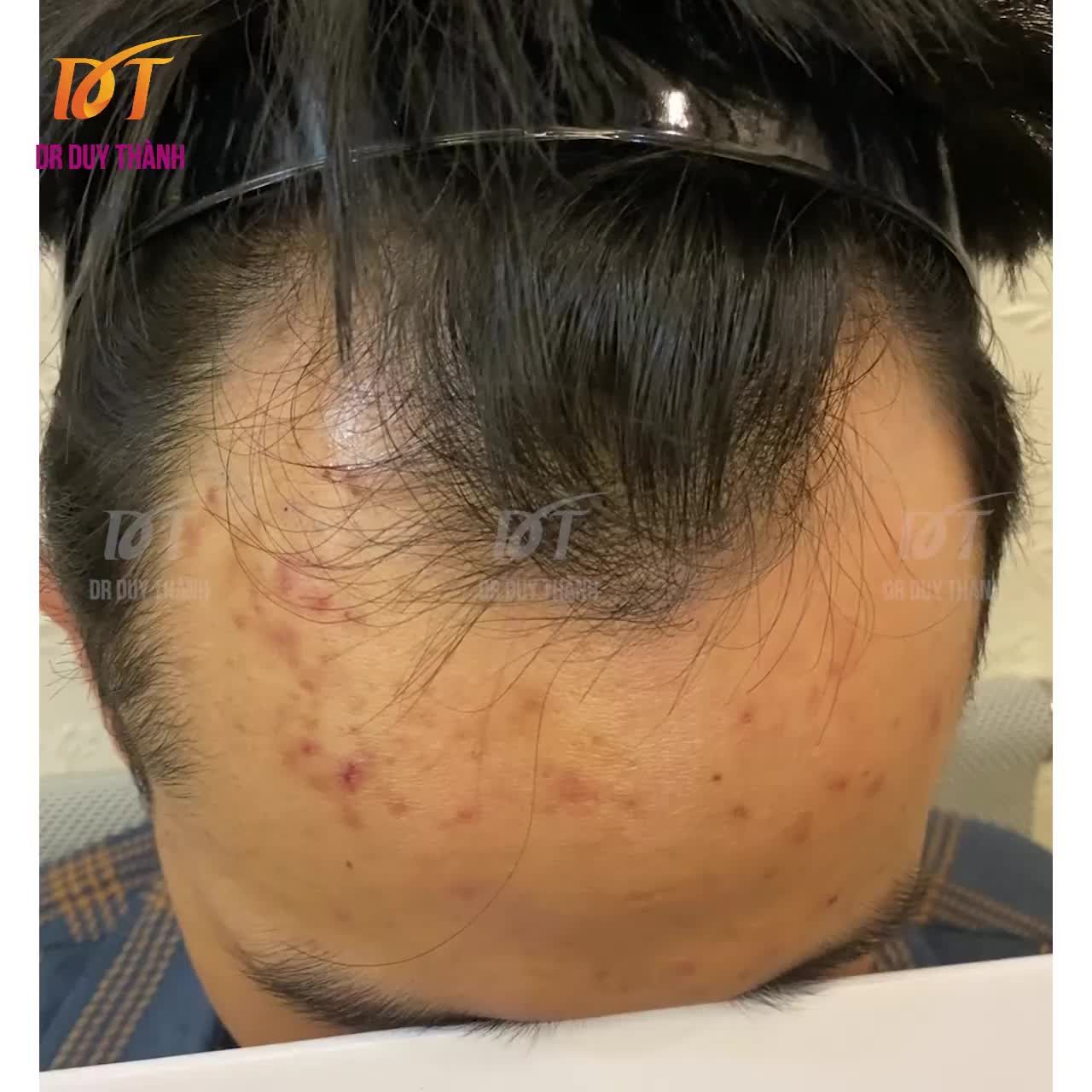 Nay mát trời lên video của ca cấy tóc 1325 nang tóc ngày hôm qua, mời anh em cùng thẩm ạ