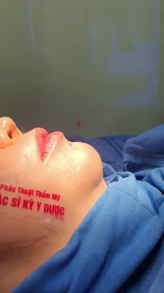 GIẢI CỨU CẰM HỎNG SAU 10 NĂM - ĐỘN CẰM GOLDEN V