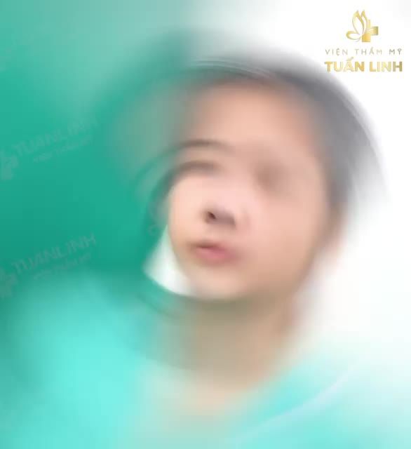 TOÀN CẢNH QUÁ TRÌNH NÂNG MŨI SỬA LẠI BỌC SỤN CÂN CƠ THÁI DƯƠNG CHO KHÁCH HÀNG ĐẾN TỪ ĐỒNG THÁP!!!