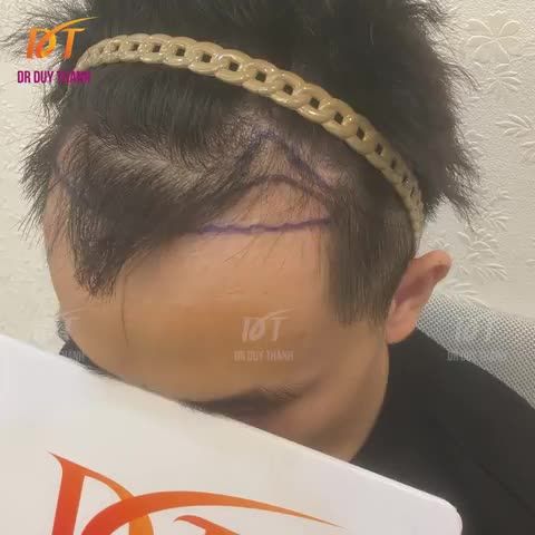 Trước và ngay sau khi cấy 1400 nang tóc chữa hói chữ M cho bạn nam đến từ Thành phố Cảng.