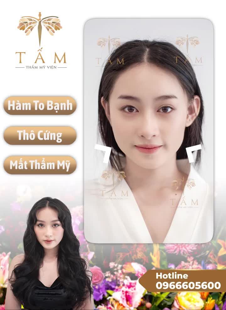 Ưu điểm của Tiêm Botox Gọn Hàm