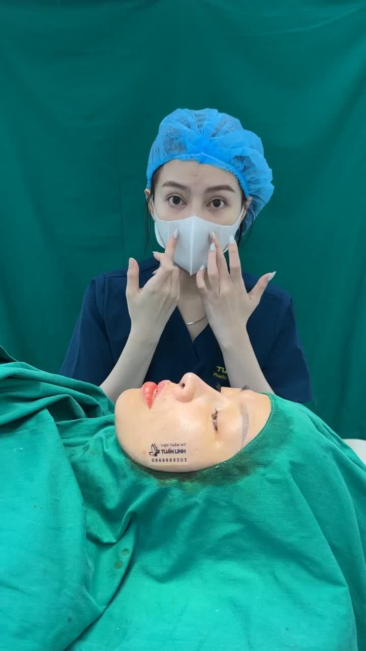 Case Nâng mũi siêu cấu trúc Surgiform + Độn rãnh cười hoàn thành sau 120 phút
