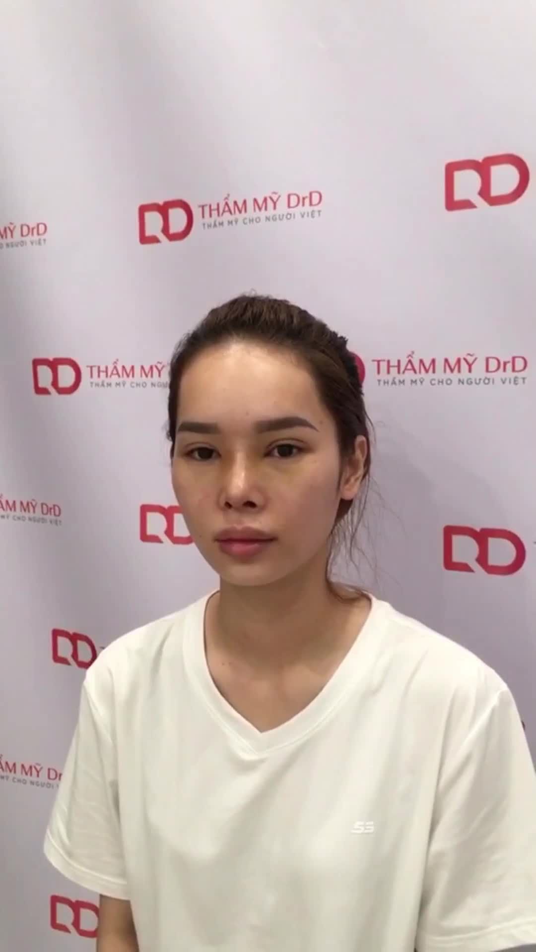 KẾT QUẢ COMBO NÂNG MŨI CẤU TRÚC DFORM + CẮT MÍ ELITE EYES