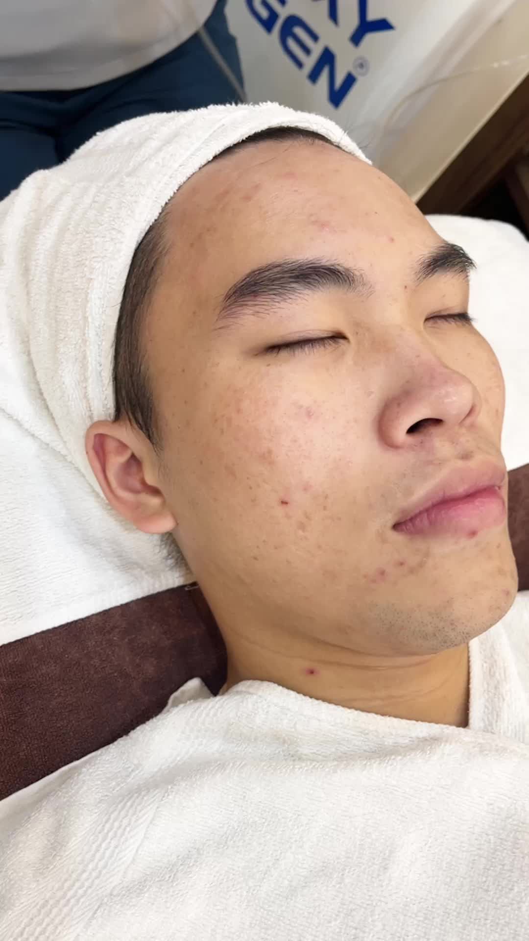 quy trình làm sạch da - Điều trị mụn De-acne tại Kangnam
