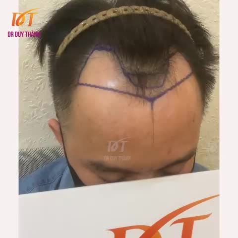 Trả kết quả đầy đủ cho anh em, ca cấy tóc 1650 nang hôm nay nhé.