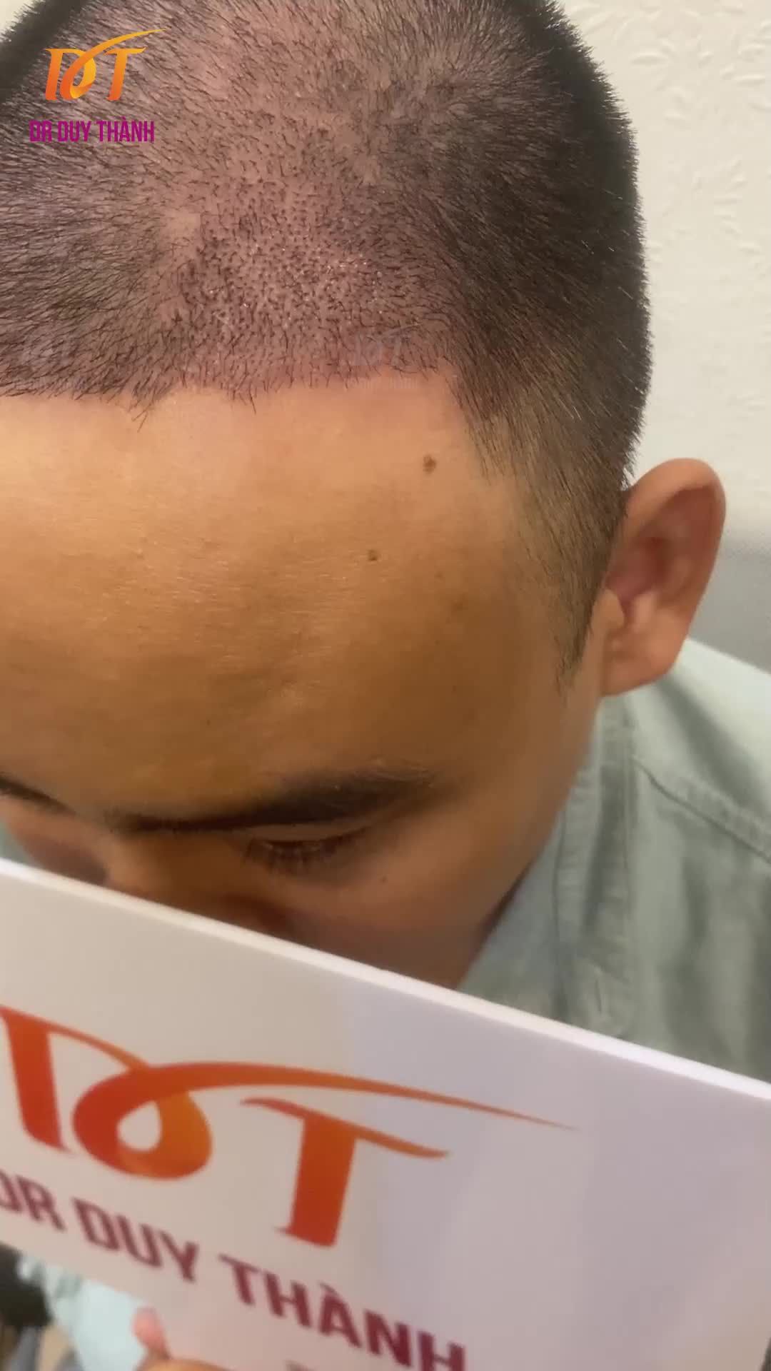 Hình ảnh 12 ngày sau cấy tóc tự thân, đã bong vảy hoàn toàn, tóc mọc tốt, đều đẹp.