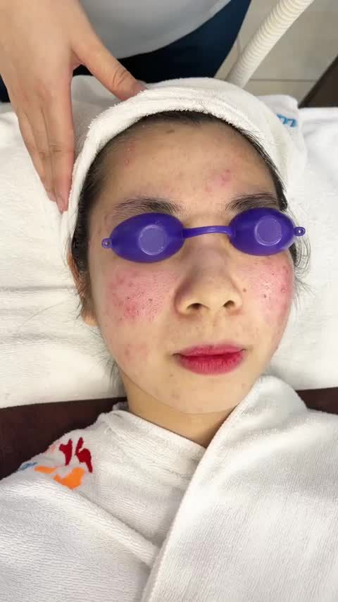 Dưỡng da sau điều trị mụn Công nghệ De-acne tại Kangnam