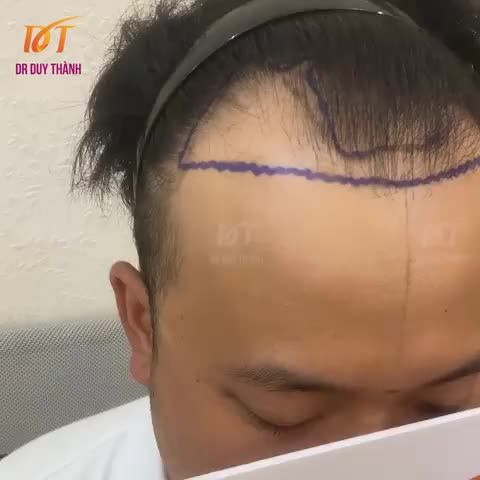 GỬI ANH EM KẾT QUẢ CẤY 1850 NANG TÓC (PHIÊN 1) CỦA BẠN NAM TỪ NHẬT BẢN BAY VỀ NHÉ!