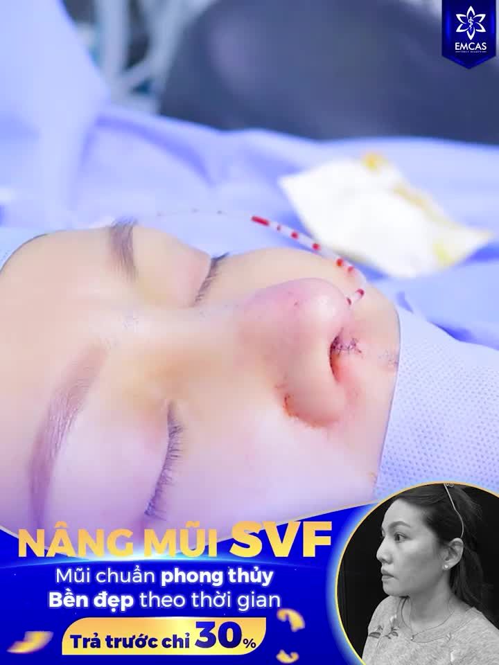 NÂNG MŨI SVF - ĐẸP CHUẨN PHONG THỦY