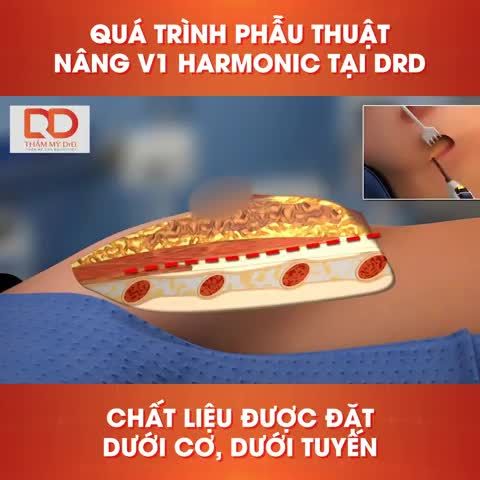 CẬN CẢNH MÔ PHỎNG QUÁ TRÌNH PHẪU THUẬT NÂNG V1