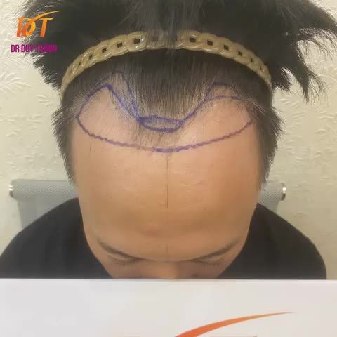 KẾT QUẢ CẤY 1800 NANG TÓC CHO KH 32 TUỔI ĐẾN TỪ QUẢNG NINH.