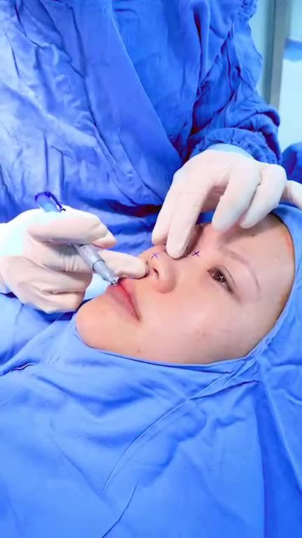 Nâng mũi 6D Sugiform - Trải nghiệm tuyệt vời, công nghệ nâng mũi mới nhất tại Kangnam!