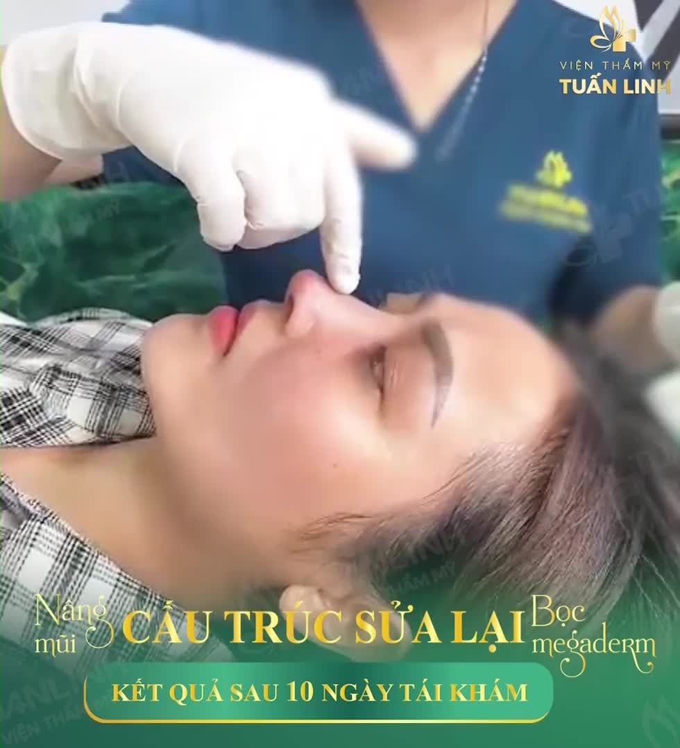 Nâng mũi cấu trúc sửa lại bọc Megaderm - Kết quả sau 10 ngày tái khám.