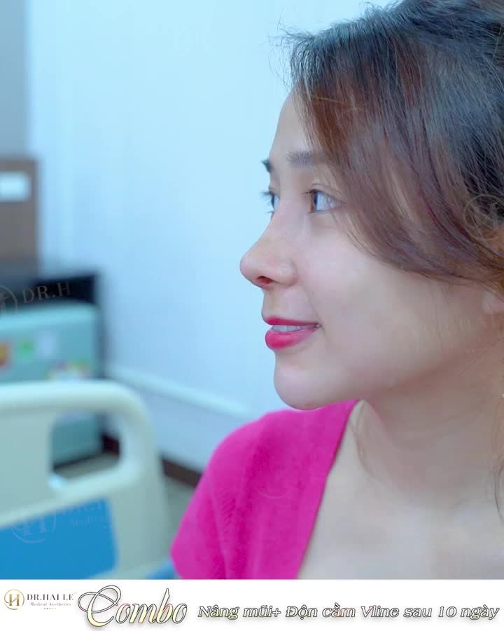 Nâng mũi + Độn cằm HCM Đẹp sang nhưng không sến!!!