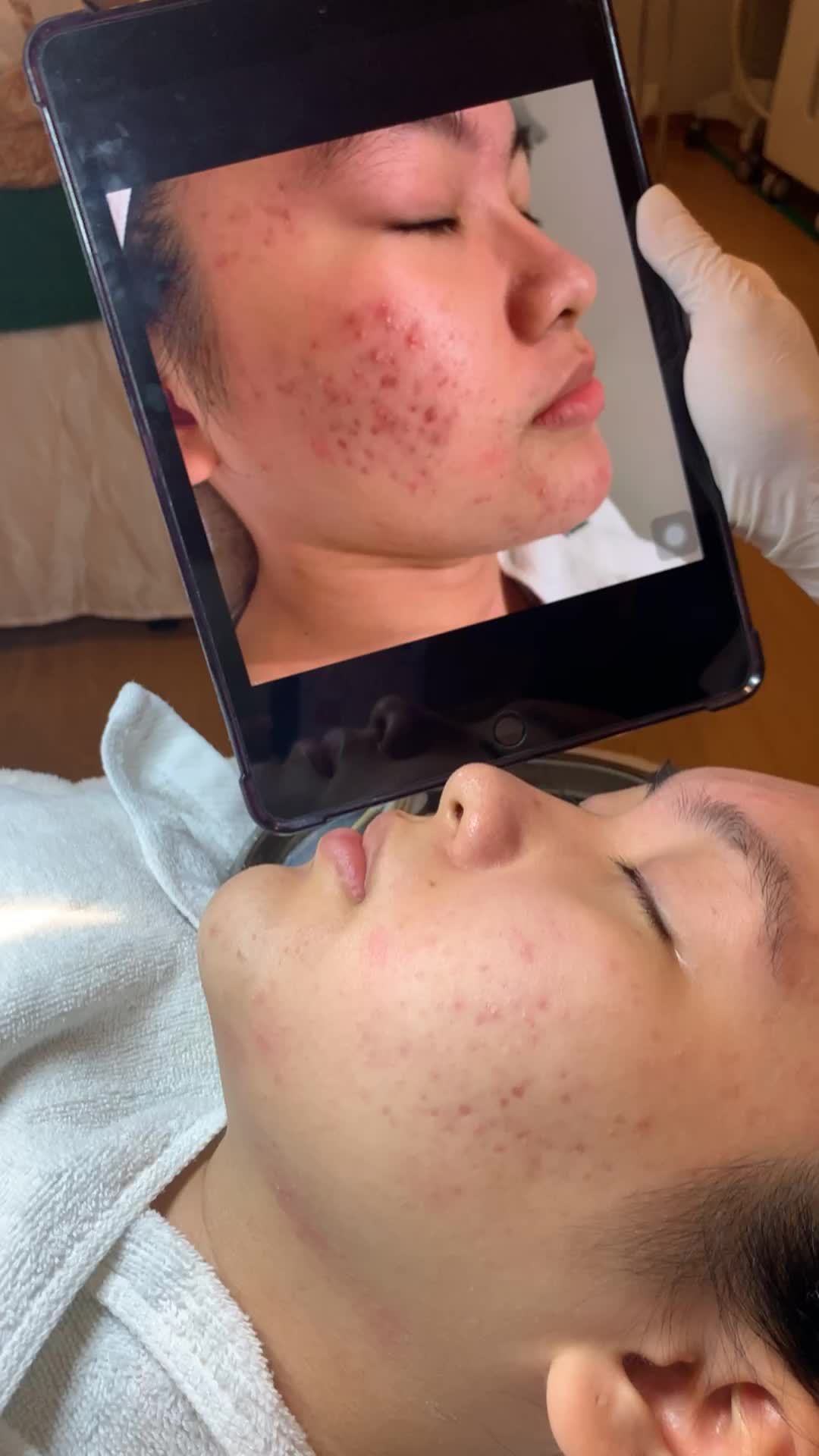 Sạch sẽ ổ viêm sau nhờ công nghệ Nano Acne của Đông Á