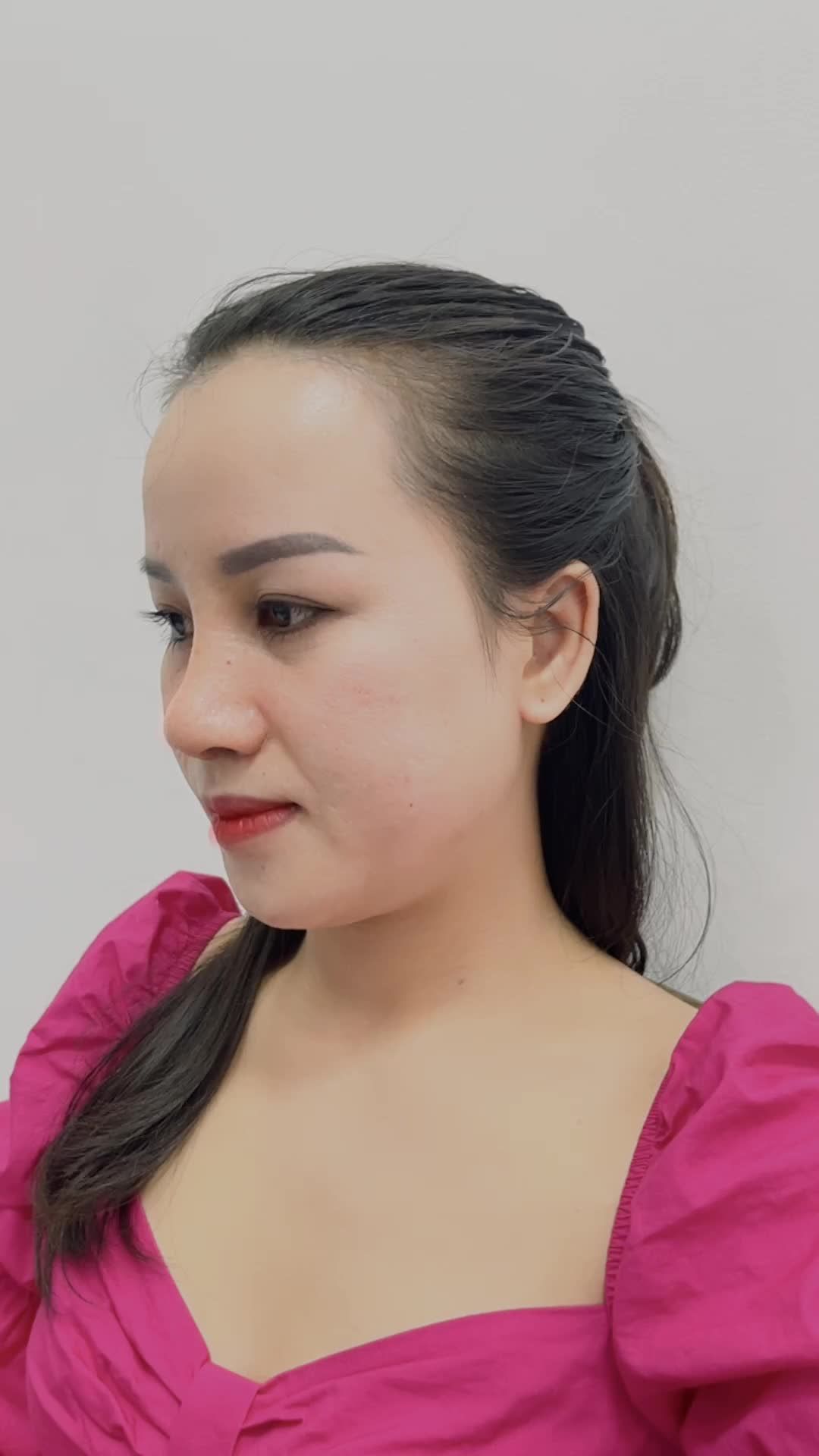 Tái cấu trúc mũi toàn diện cùng công nghệ Nâng mũi 6D kết hợp cắt cánh mũi tại Kangnam