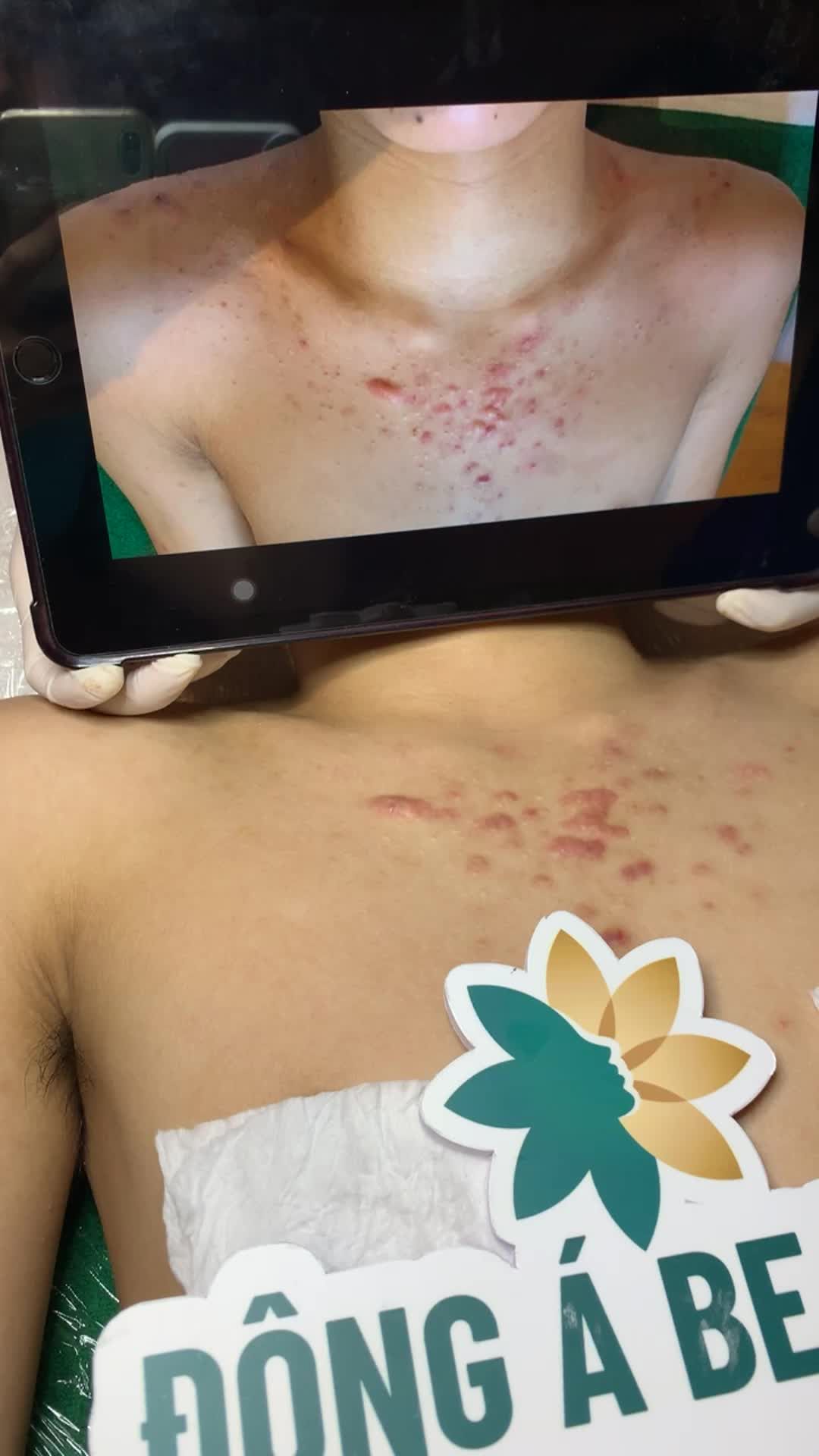 Điều trị mụn body cho bạn nam khách hàng . Từng điều trị mụn sai cách dẫn đến sẹo lồi . Xem ngay
