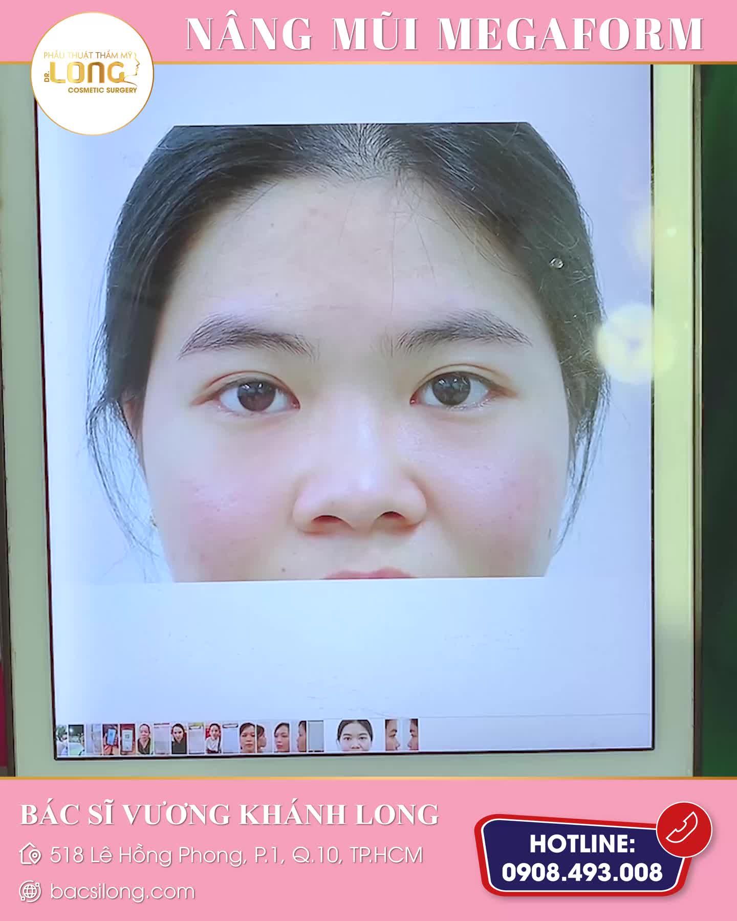 CHỈ NÂNG MŨI MÀ THAY ĐỔI “NHAN SẮC” ĐẾN VẬY SAO