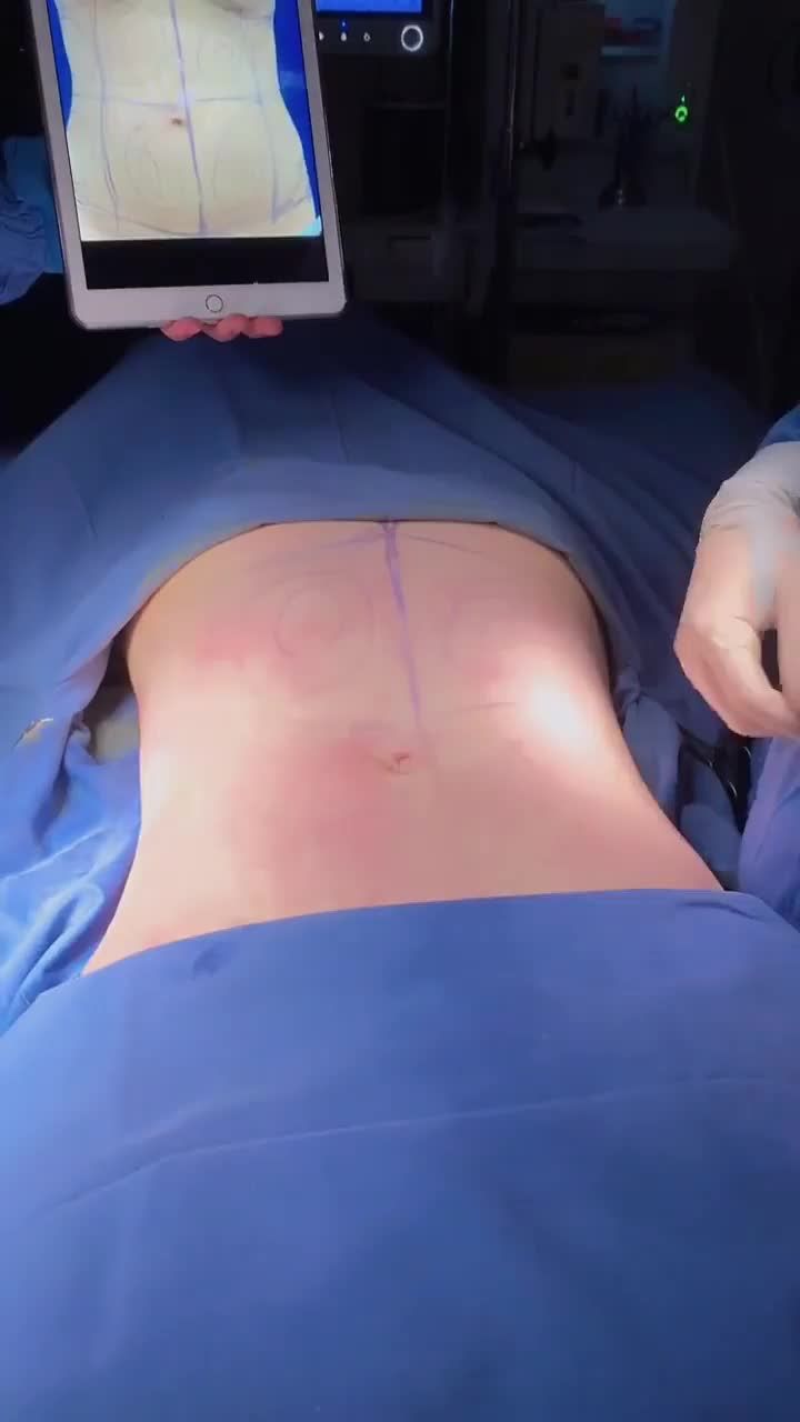 Mỡ thừa sau sinh - 90 phút biến mất hoàn toàn, có ngay eo thon sắc chắc