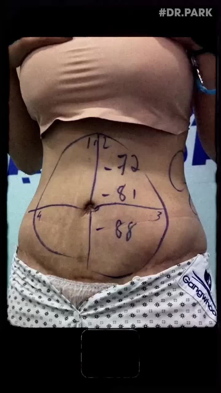 GIẢM MỠ KHÔNG PHẪU THUẬT CÙNG BÁC SĨ PHÙNG MẠNH CƯỜNG