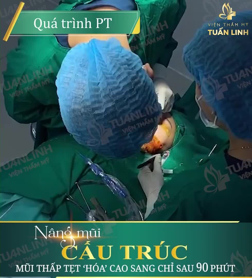 SỞ HỮU NGAY DÁNG MŨI CAO SANG CHỈ SAU 90 PHÚT = TƯ VẤN NGAY