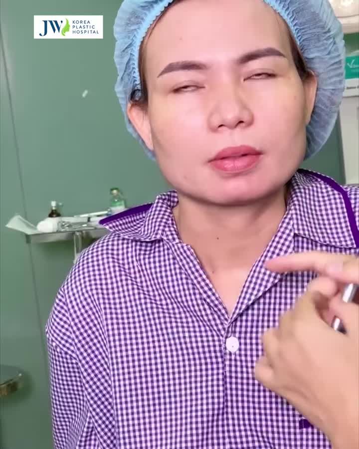 SỮNG SỜ quý cô MẶT CHỮ ĐIỀN được Bác sĩ Tú Dung Gọt mặt V Line Độn cằm hoá mỹ nữ ĐẸP NGẤT NGÂY