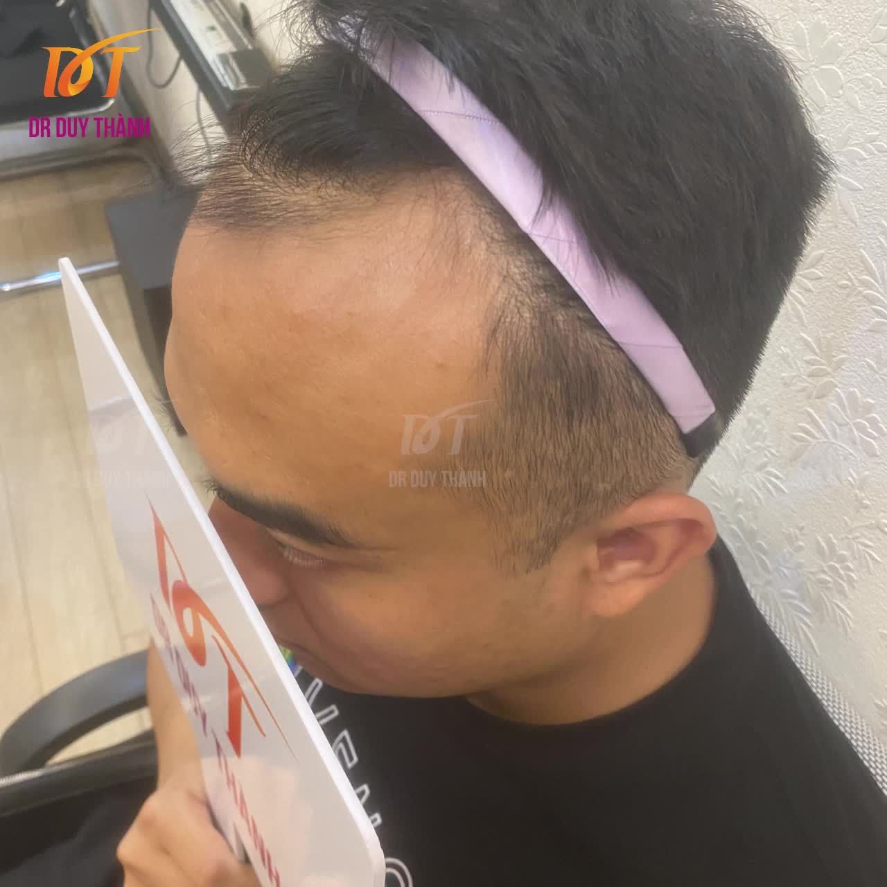 VIDEO FULL CẤY 1500 NANG TÓC ĐẸP XUẤT SẮC, BÁC SĨ CƯỜI TƯƠI ROI RÓI.