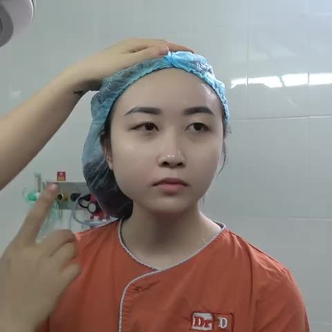 Nàng thắc mắc nếp mí trước và sau Cắt mí Elite Eyes thế nào
