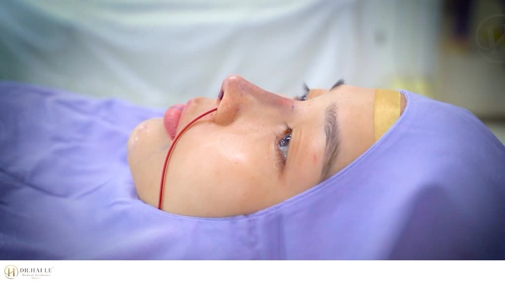 Review Nâng mũi + Độn cằm HCM Đẹp sang nhưng không sến!!!