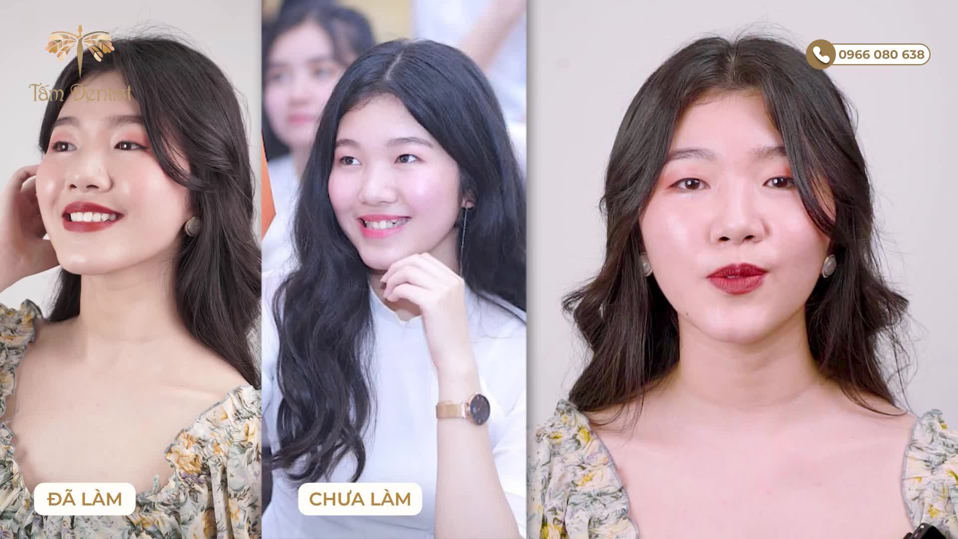 CHỌN NIỀNG RĂNG KHÔNG ĐAU - CHỌN TẤM DENTIST