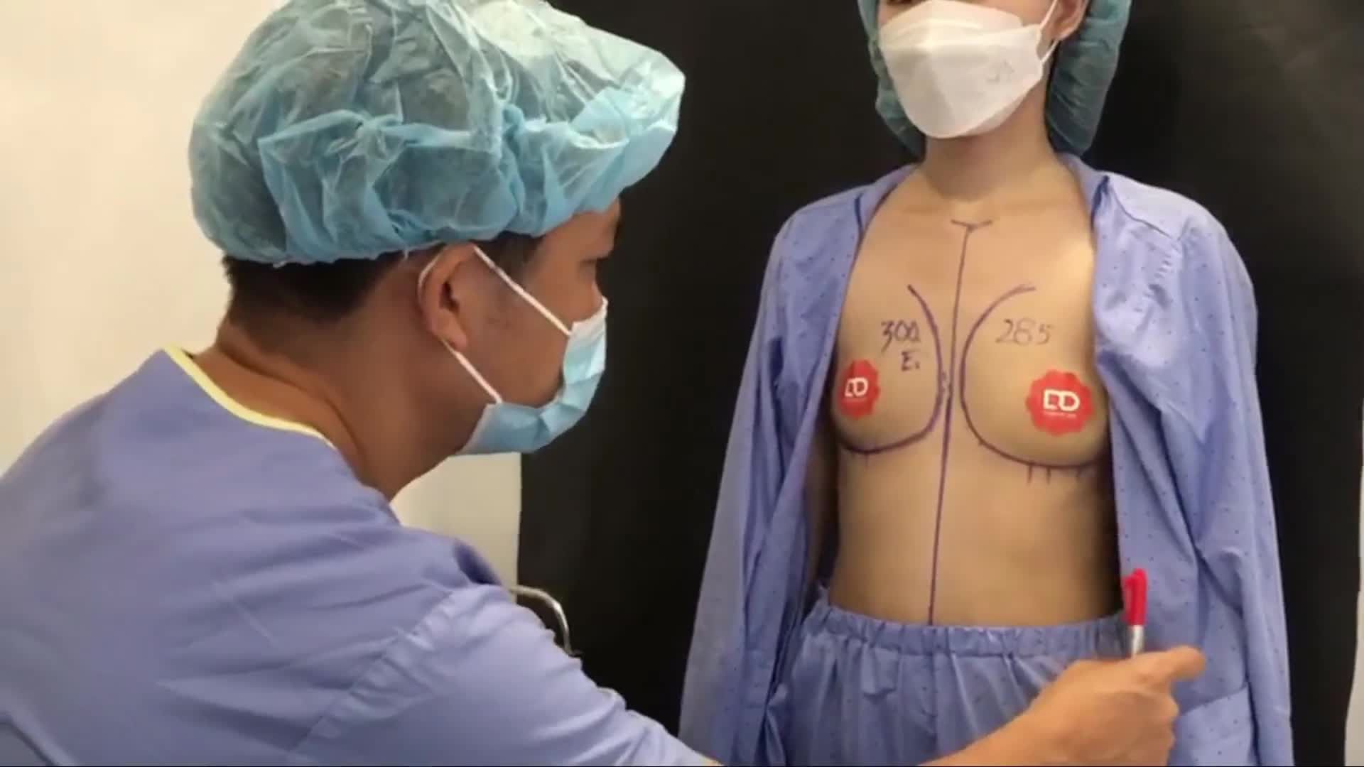 PHÂN TÍCH TRƯỚC PHẪU THUẬT CA NGỰC LỆCH, BÁC SĨ SẼ CHỈ ĐỊNH SIZE NGỰC BAO NHIÊU