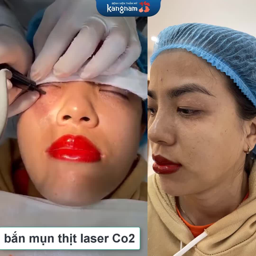 Đốt mụn thịt Laser CO2 Fractional không lo sẹo