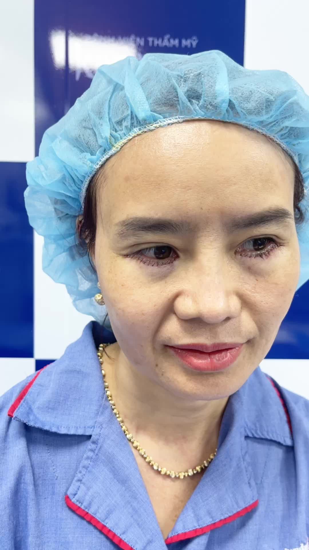 Thực hiện cắt mí dưới 6D tại Kangnam