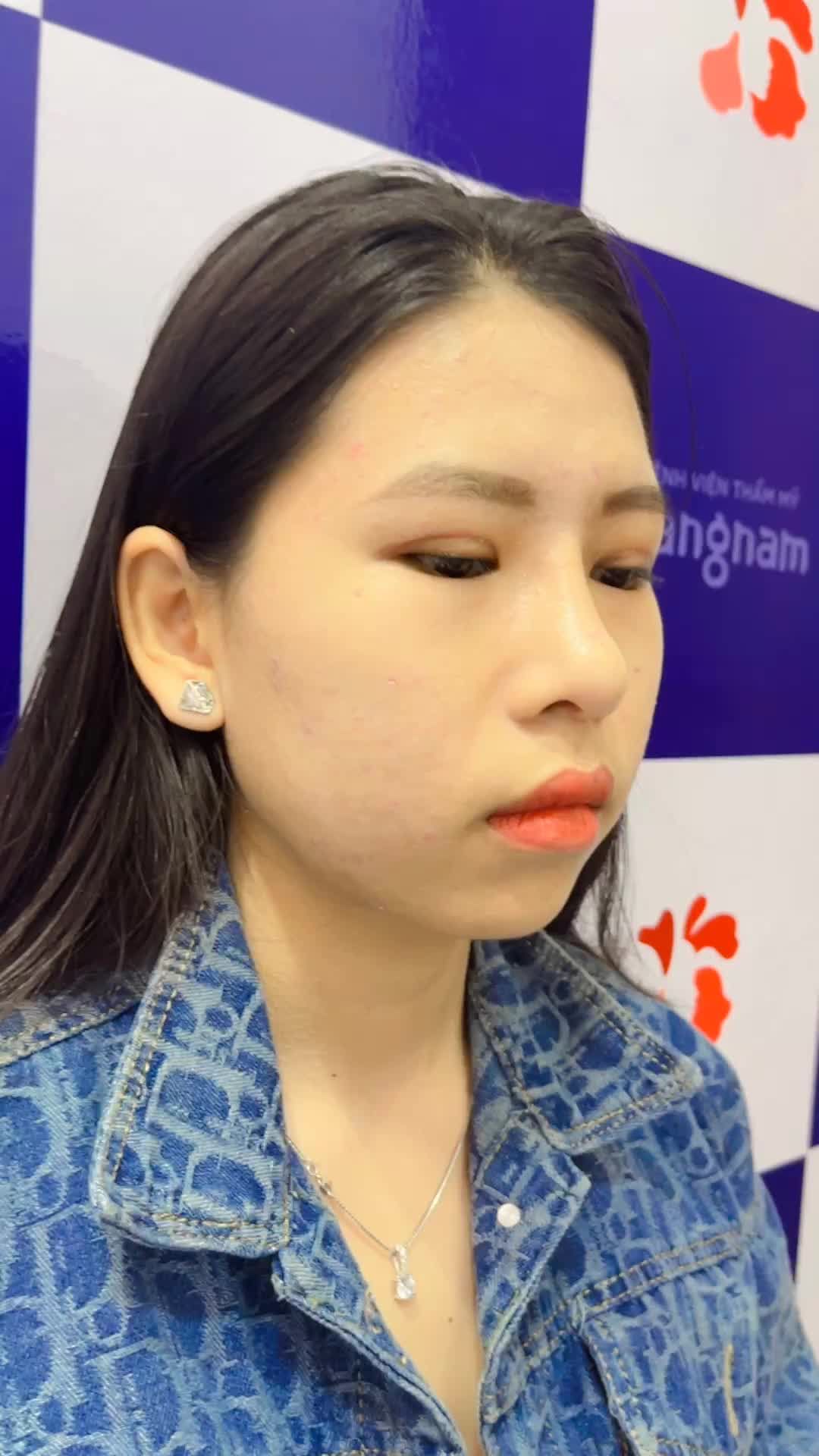 Thay đổi ngoạn mục cùng Combo Cắt mí 6D và Nâng mũi 6D VIP tại kangnam